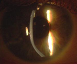 Bent light beam from microscope shows the abnormal shape of the cornea
