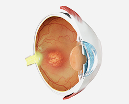 Age-Related Macular Degeneration (AMD)