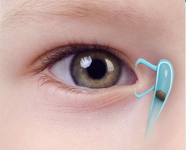 Blocked Tear Ducts in Children