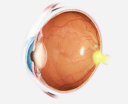 Cataract Surgery