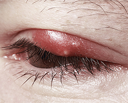 Chalazion in Children