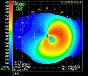 Corneal topography or  mapping shows the abnormal shape