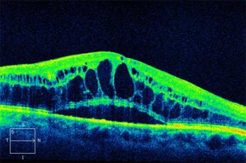 Diabetic macular oedema demonstrated on OCT