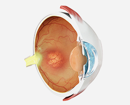 Diabetic Retinopathy