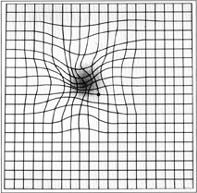 Distortion of central vision detected on an Amsler grid