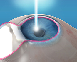 Laser Vision Correction