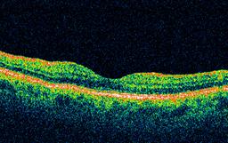 Normal OCT scan of the Macula