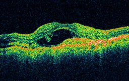 OCT scan of Wet AMD showing leakage and swelling