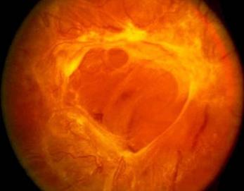 Proliferative diabetic retinopathy