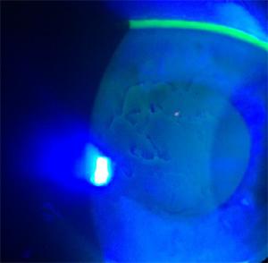 Outline of old erosion on the front surface of the cornea