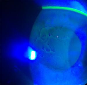  Outline of old erosion on the front surface of the cornea