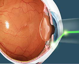 Selective Laser Trabeculoplasty