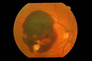 Wet AMD - Sudden Bleeding at the Macula